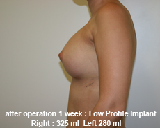 plastic-surgery-breast-augmentation